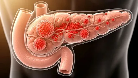 Pancreatic Cancer