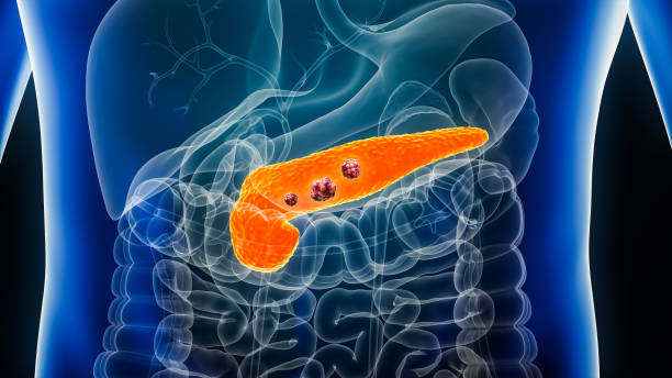 Why Is Pancreatic Cancer So Deadly